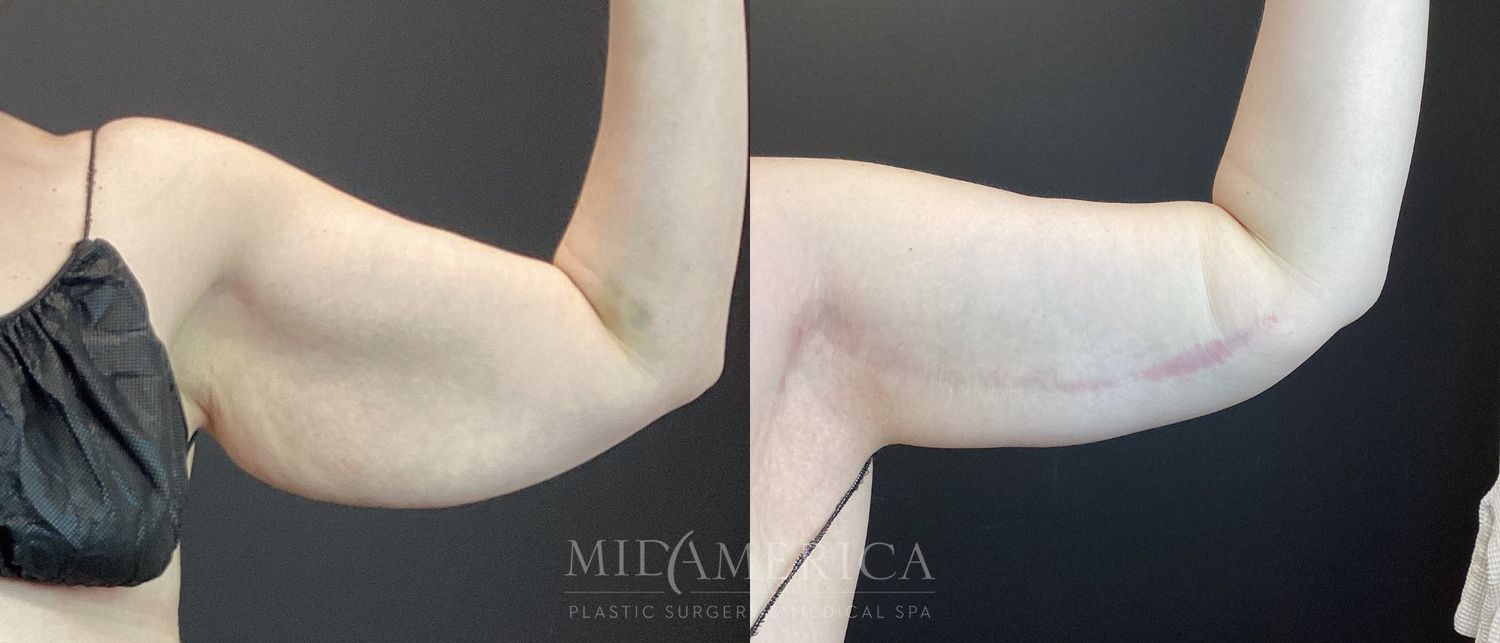 Brachioplasty Before & After