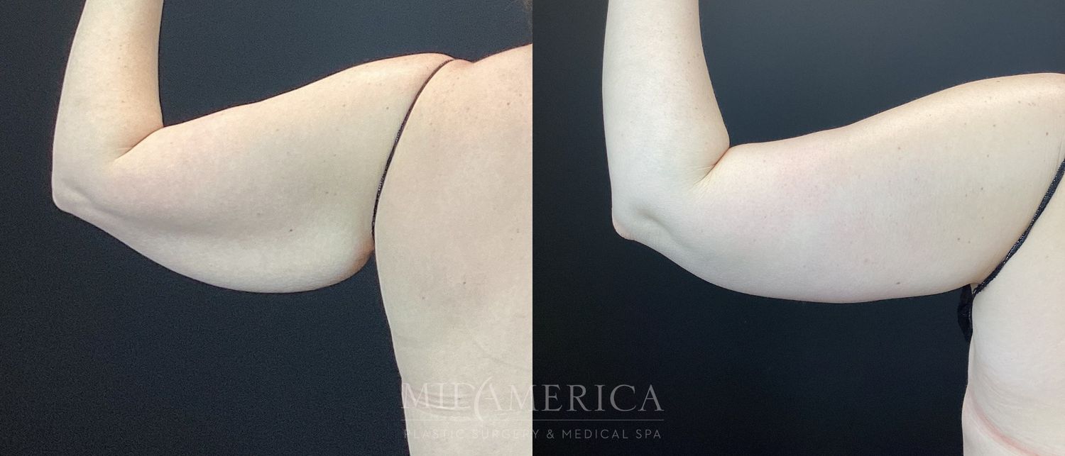 Brachioplasty Before & After