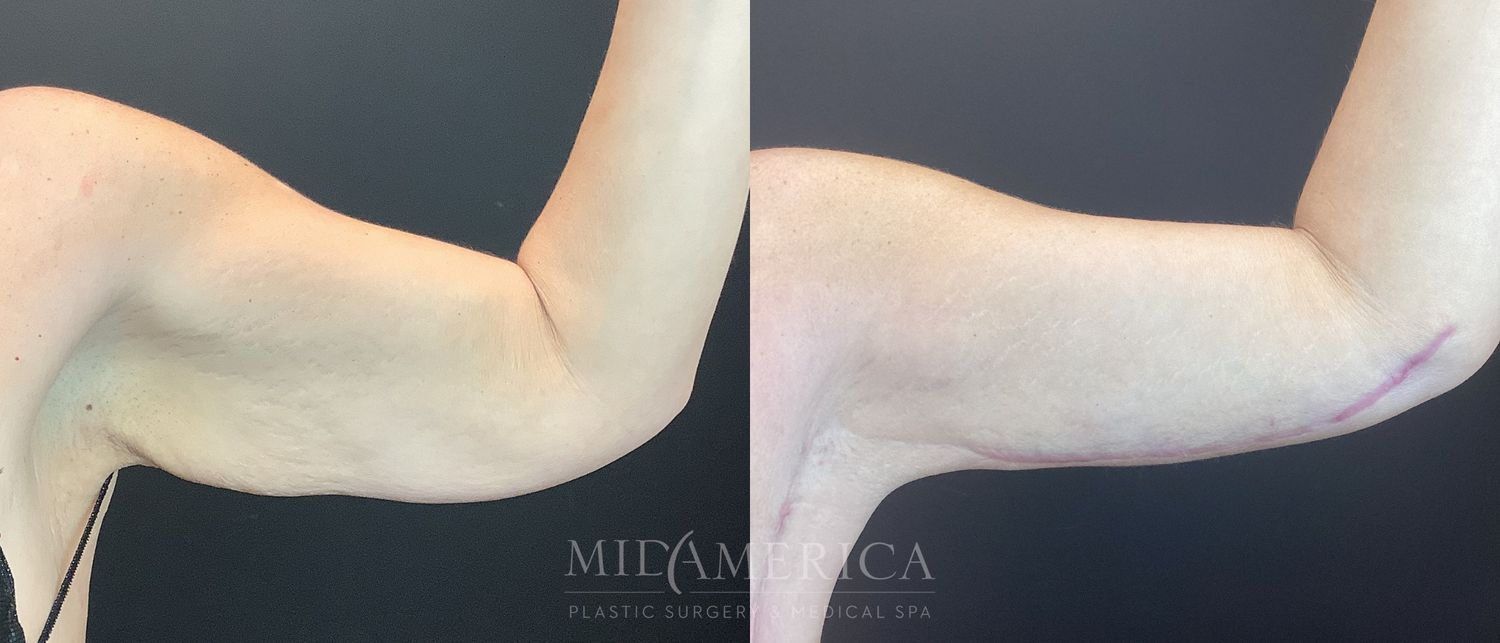 Brachioplasty Before & After