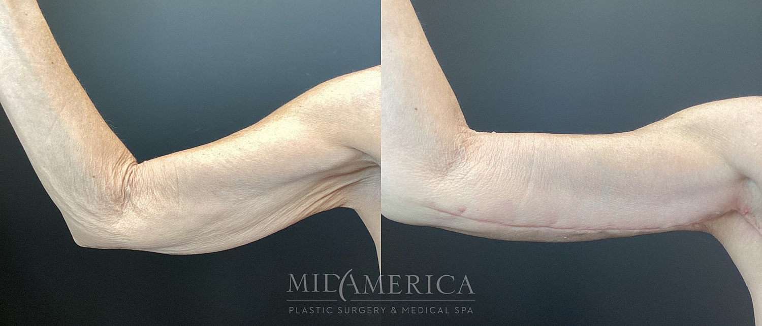 Brachioplasty Before & After