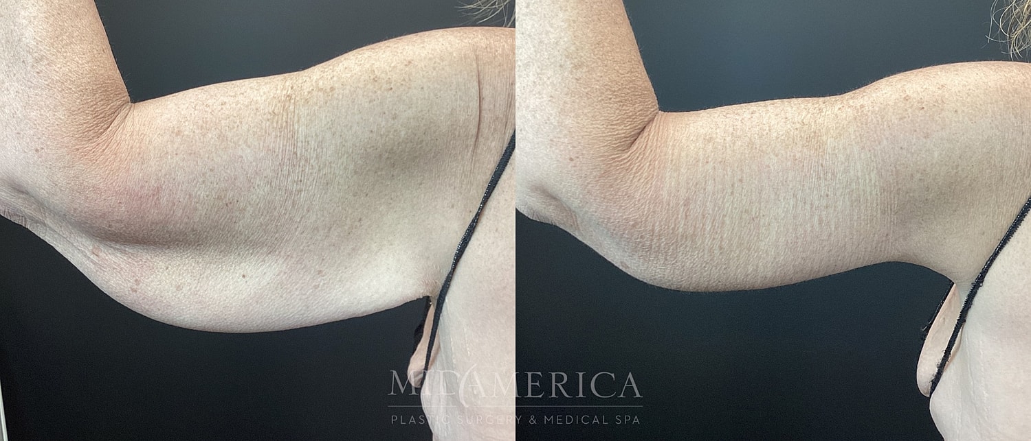 Brachioplasty Before & After