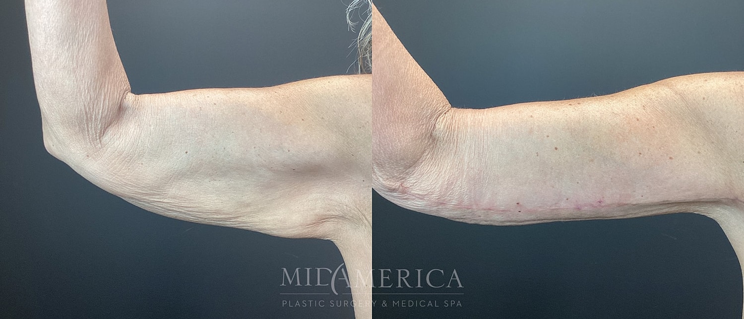 Brachioplasty Before & After