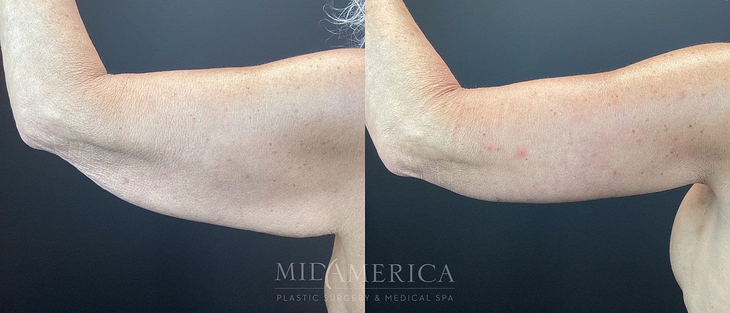 Brachioplasty Before & After