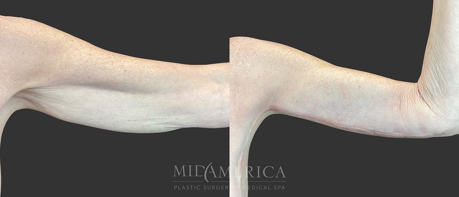 Brachioplasty Before & After