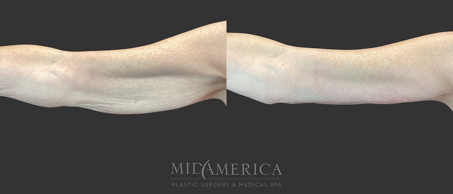 Brachioplasty Before & After
