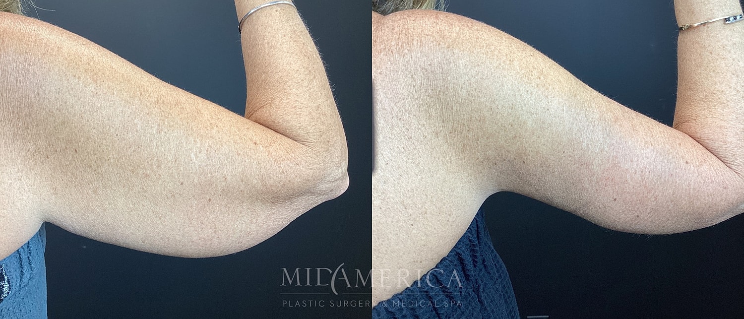 Brachioplasty Before & After