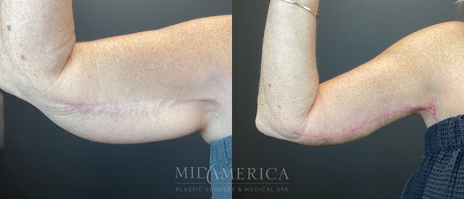 Brachioplasty Before & After