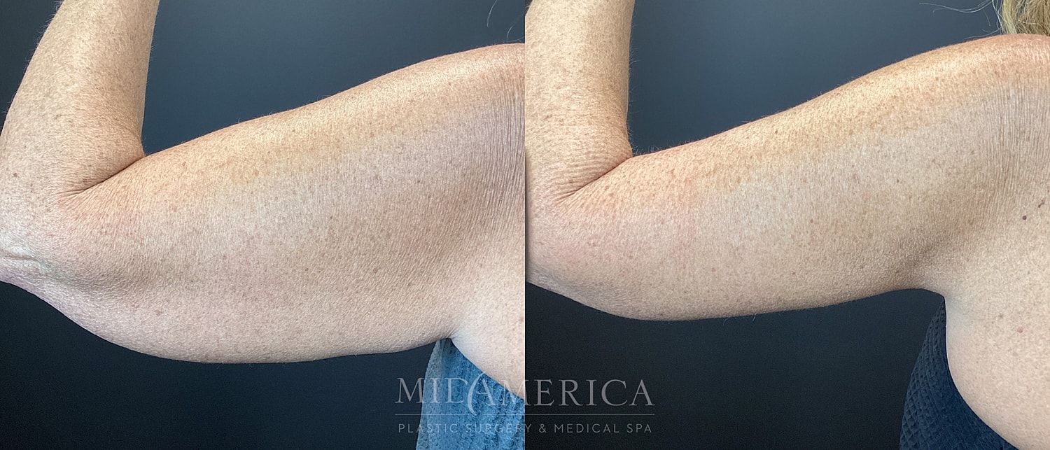 Brachioplasty Before & After