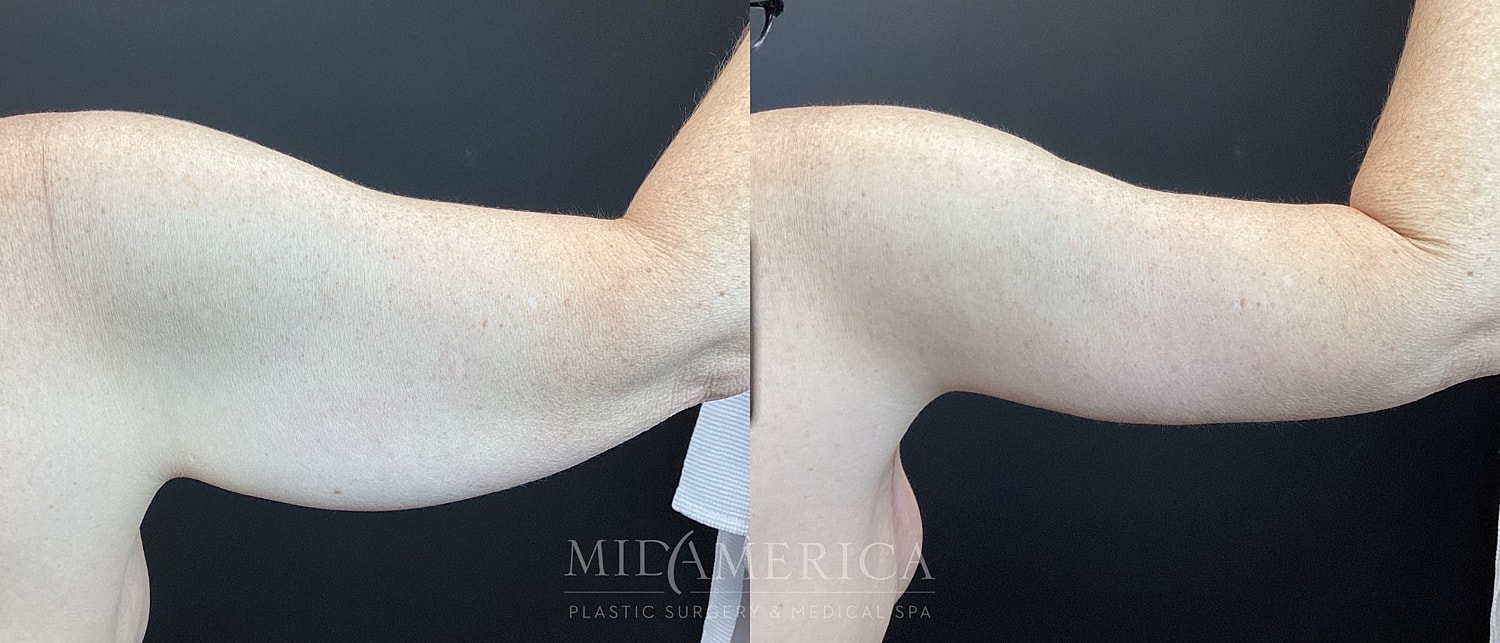 Brachioplasty Before & After