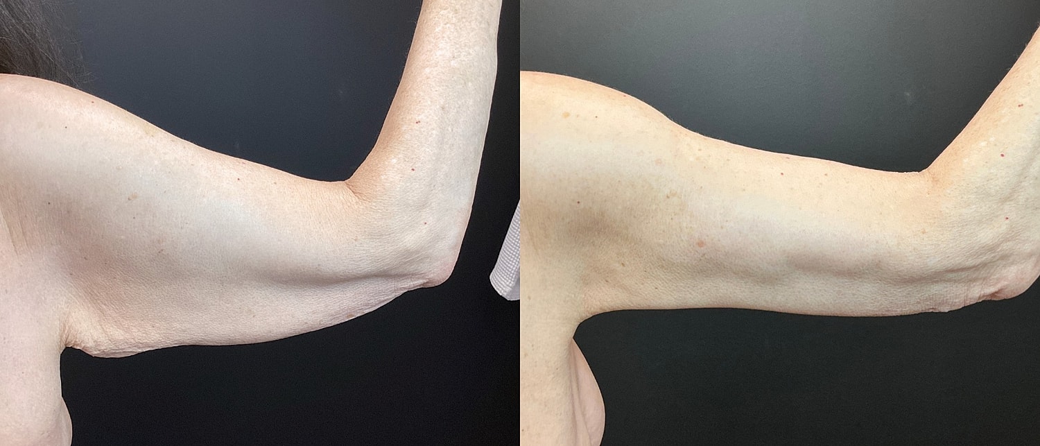 Brachioplasty Before & After