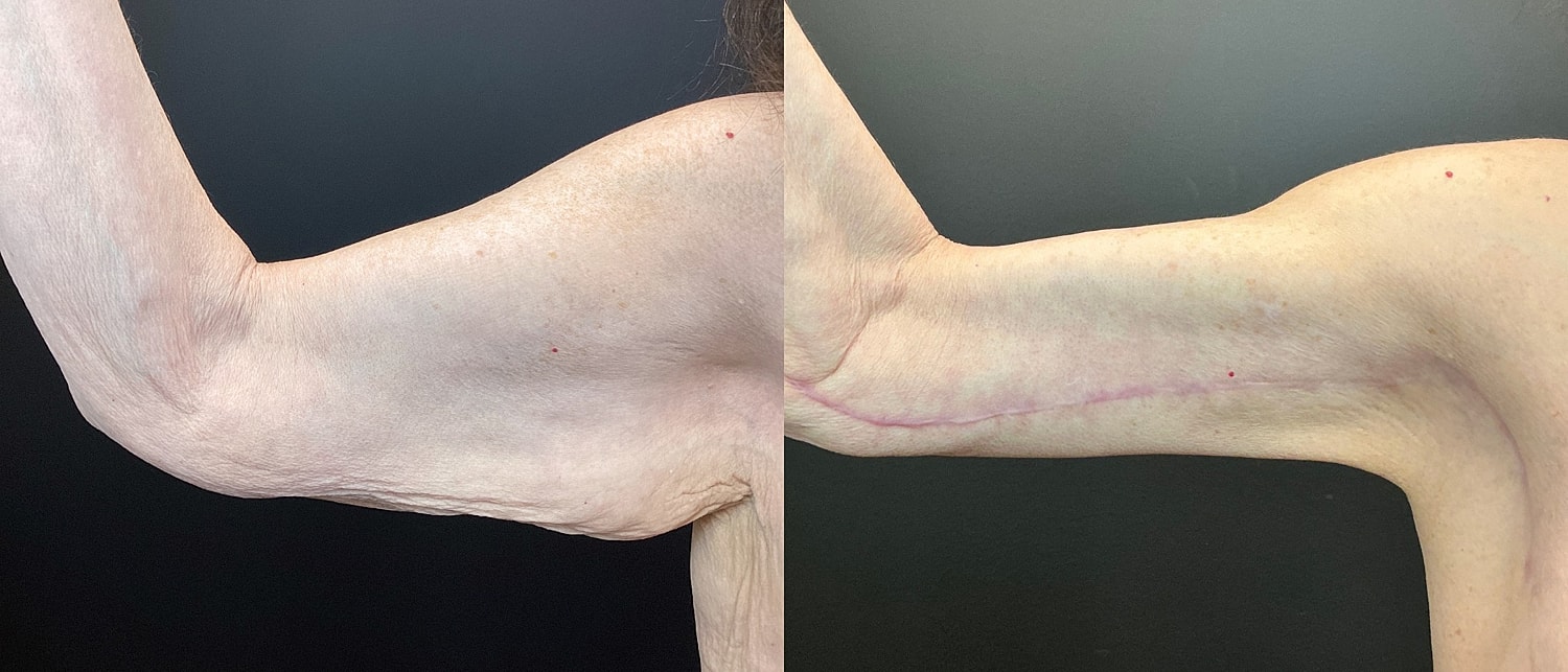 Brachioplasty Before & After