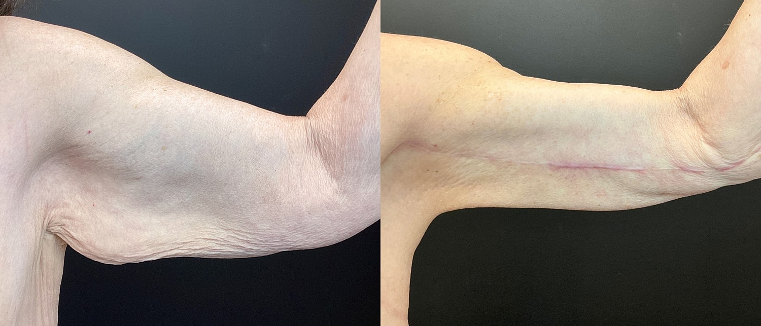 Brachioplasty Before & After