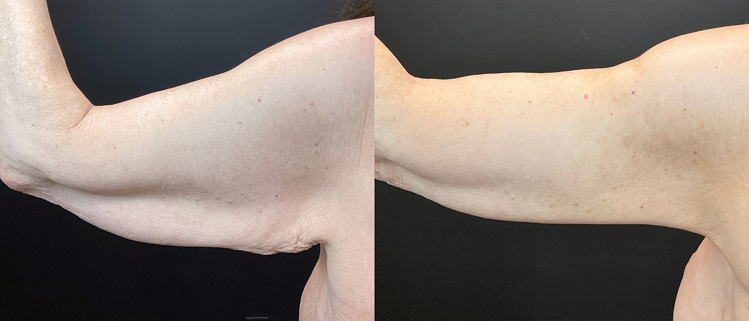 Brachioplasty Before & After