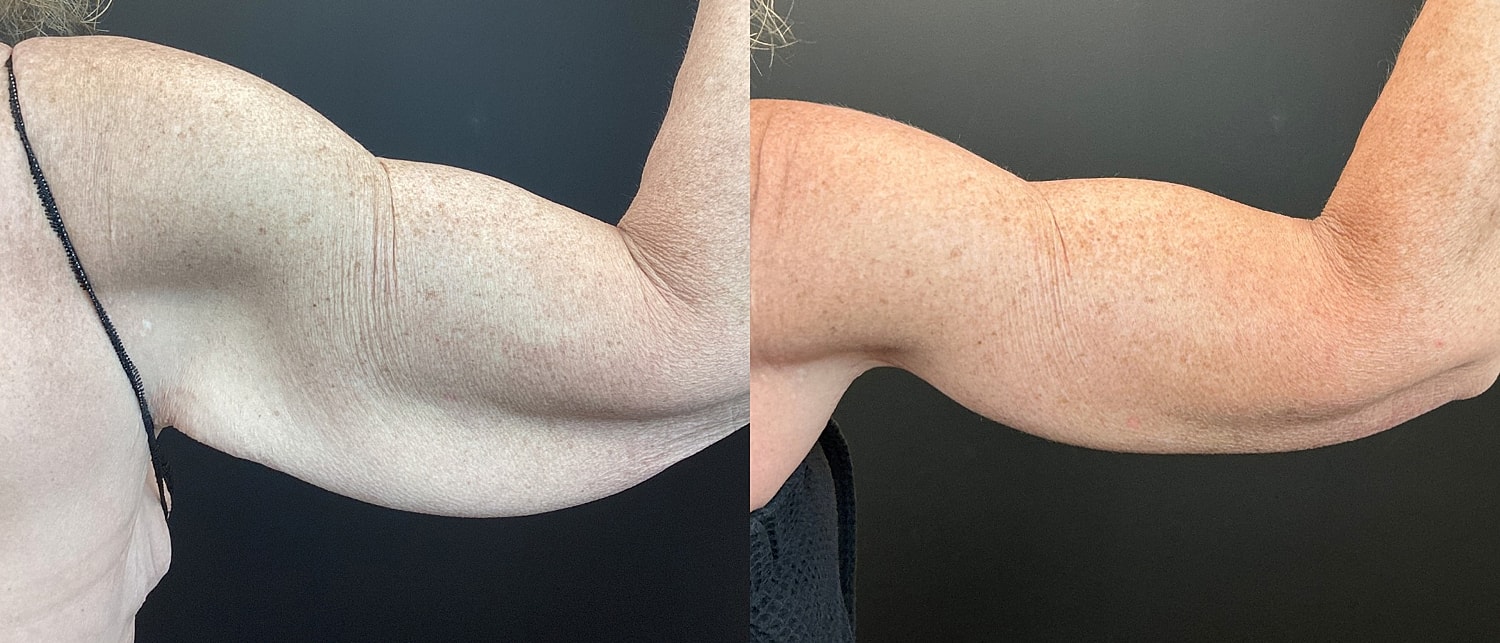 Brachioplasty Before & After