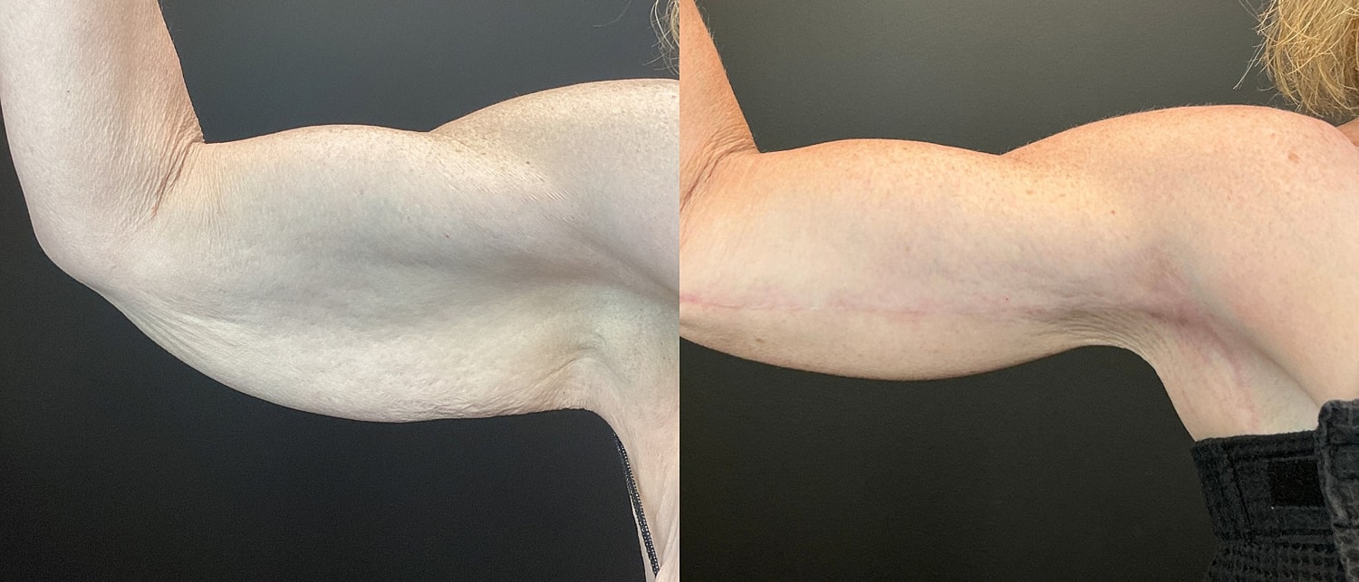 Brachioplasty Before & After