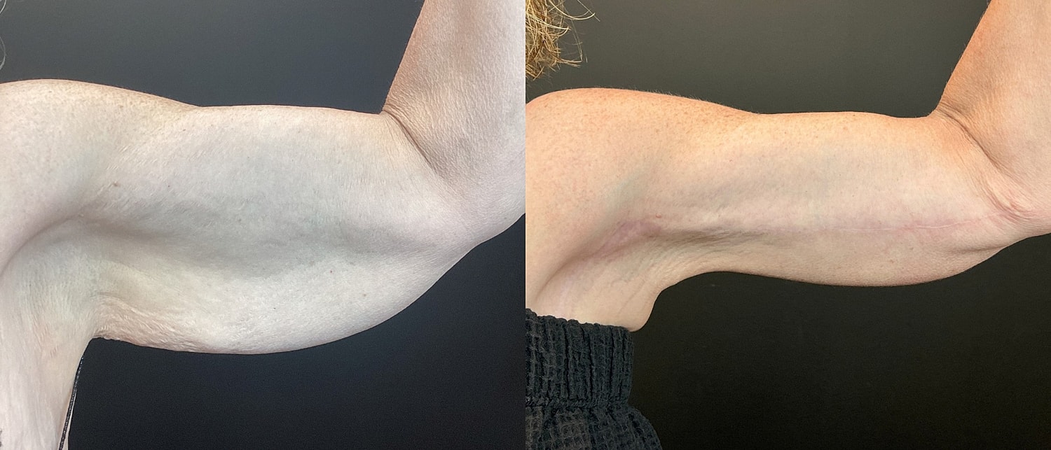 Brachioplasty Before & After