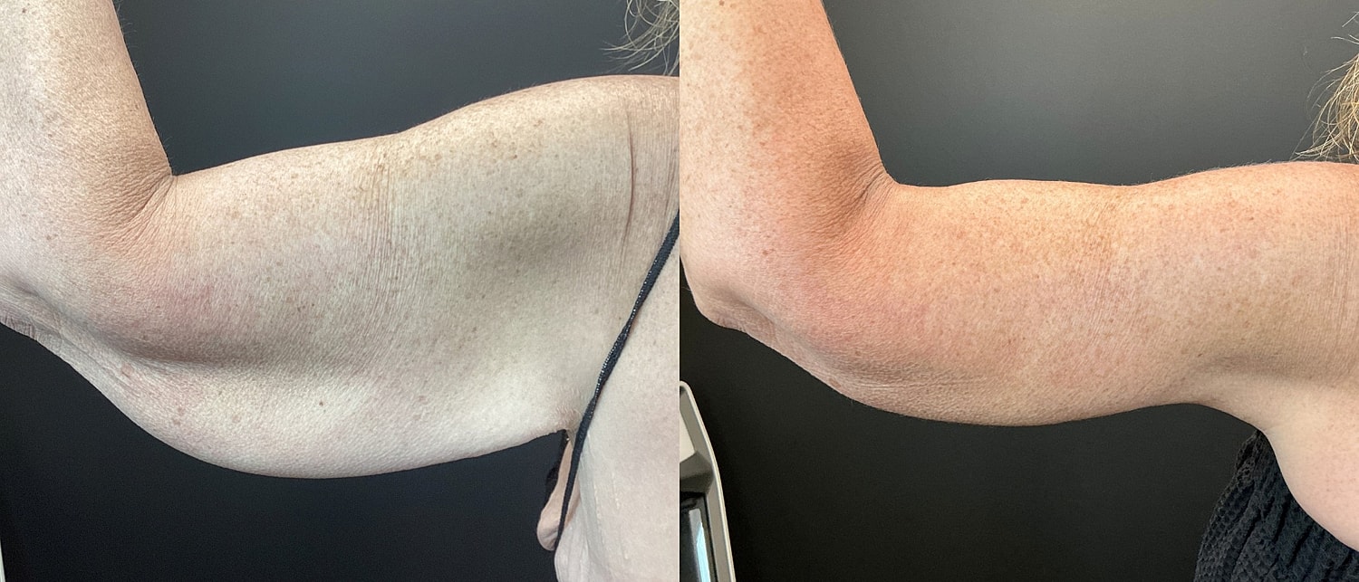 Brachioplasty Before & After