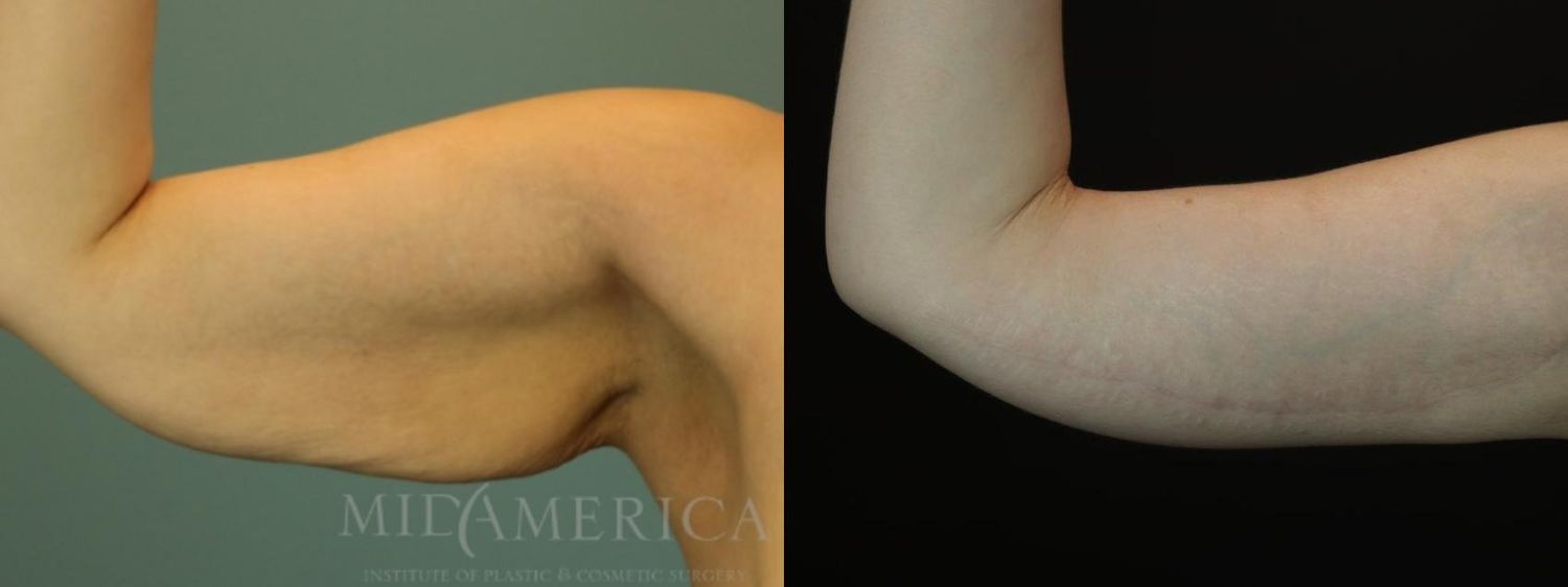 Brachioplasty Before & After