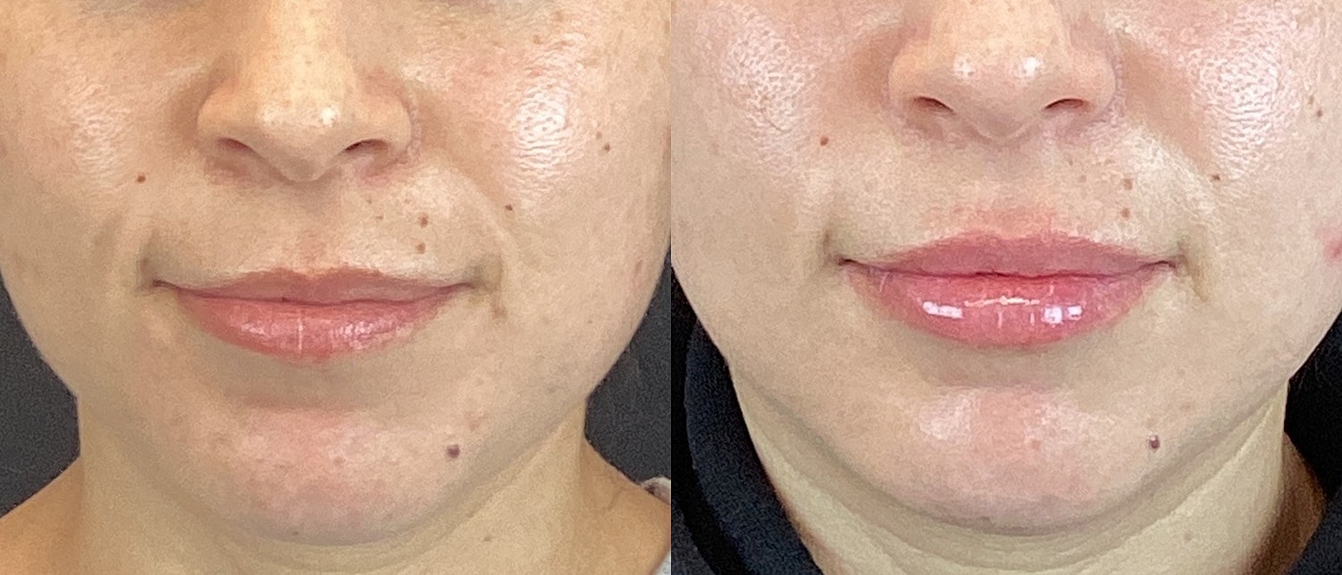 Lip Filler Before & After