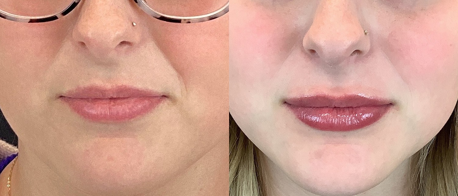 Lip Filler Before & After