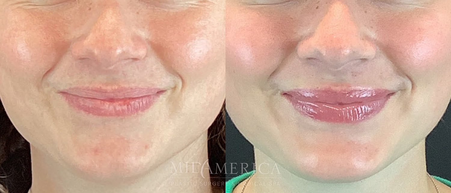 Lip Filler Before & After