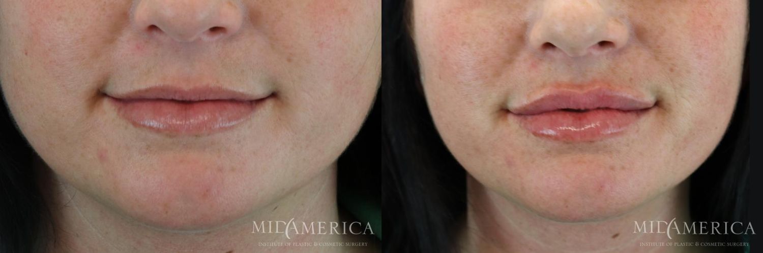 Lip Filler Before & After