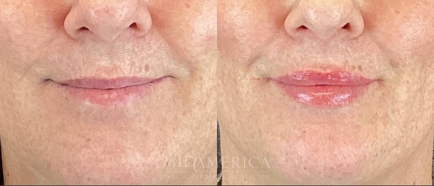 Lip Filler Before & After