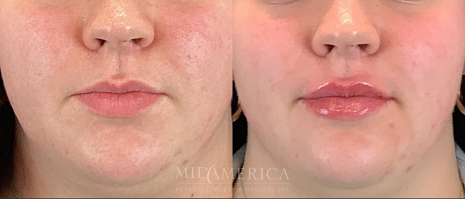 Lip Filler Before & After
