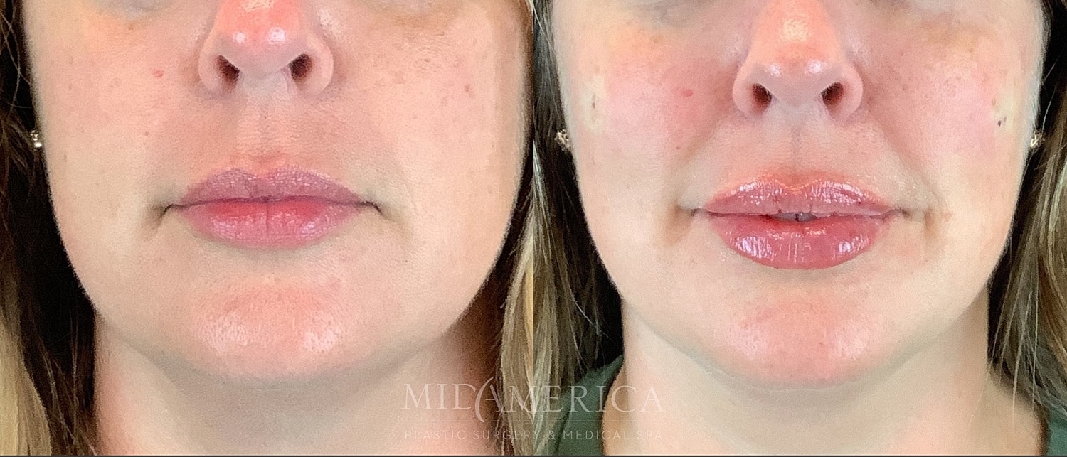 Lip Filler Before & After