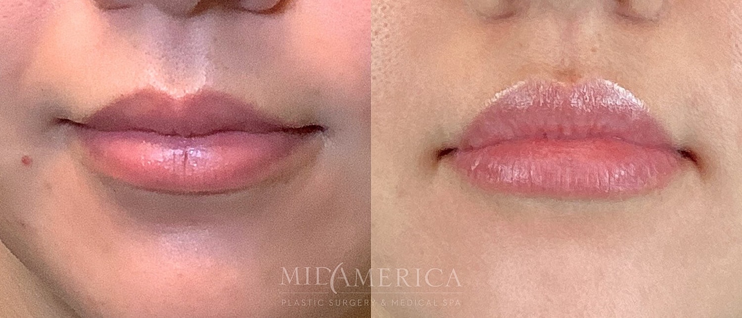Lip Filler Before & After