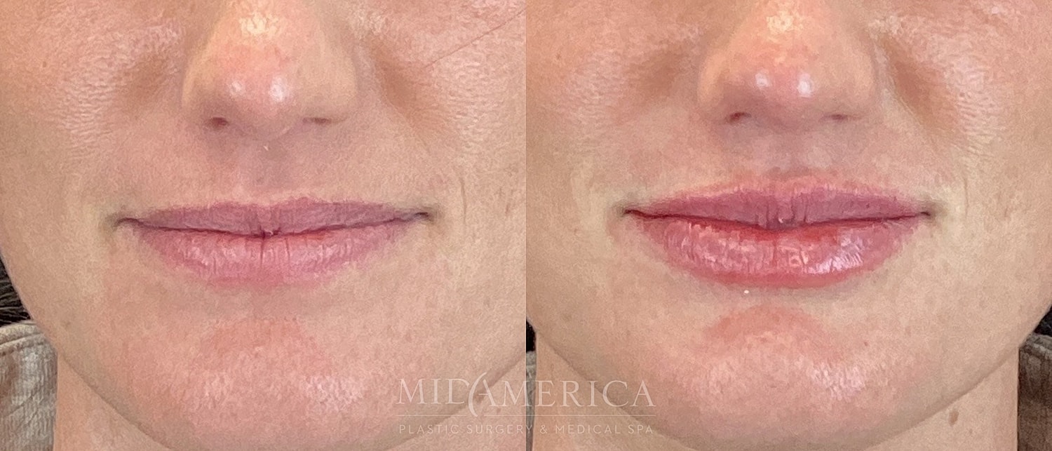 Lip Filler Before & After