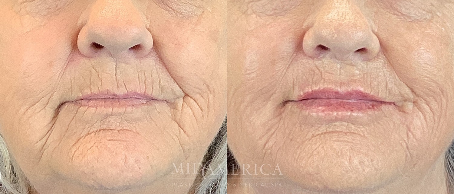 Lip Filler Before & After