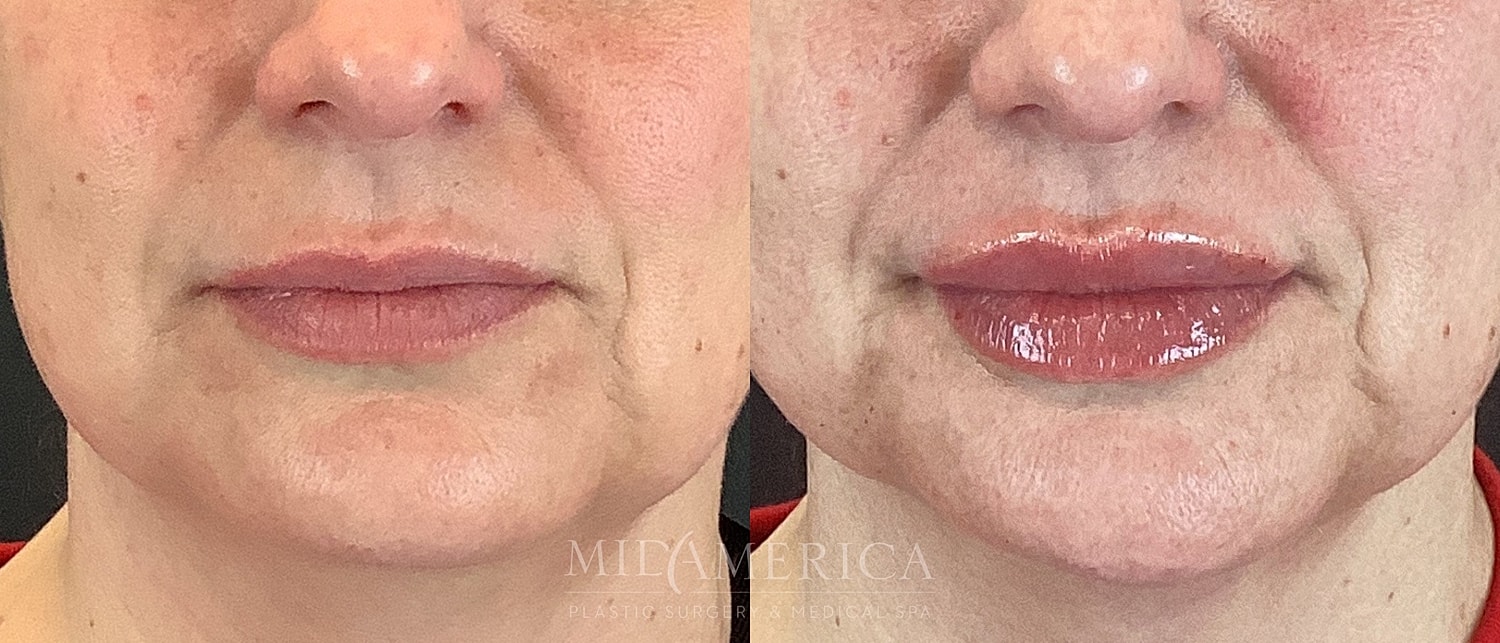 Lip Filler Before & After