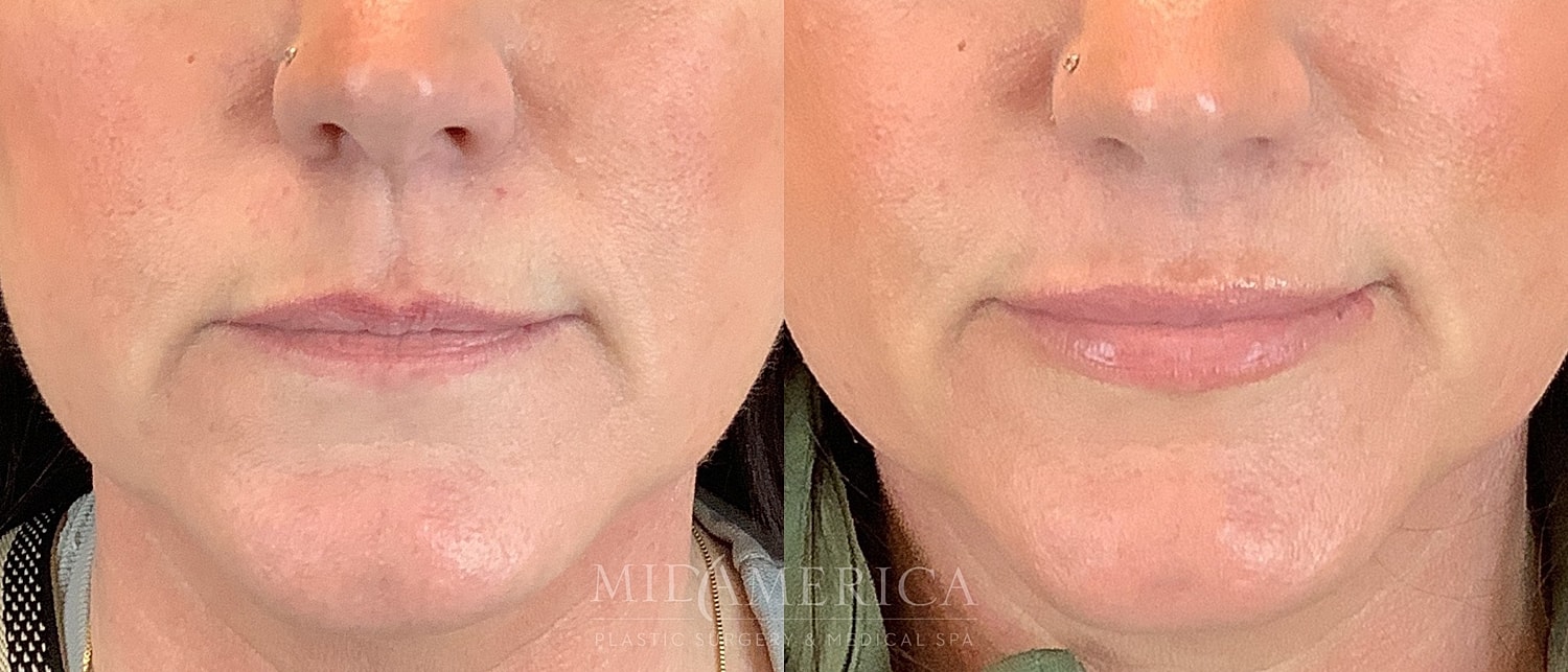 Before and after lip enhancement procedure results.