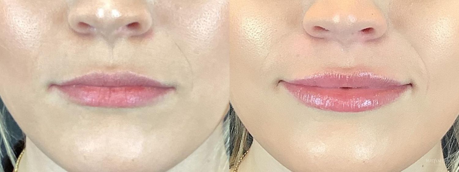 Lip Filler Before & After