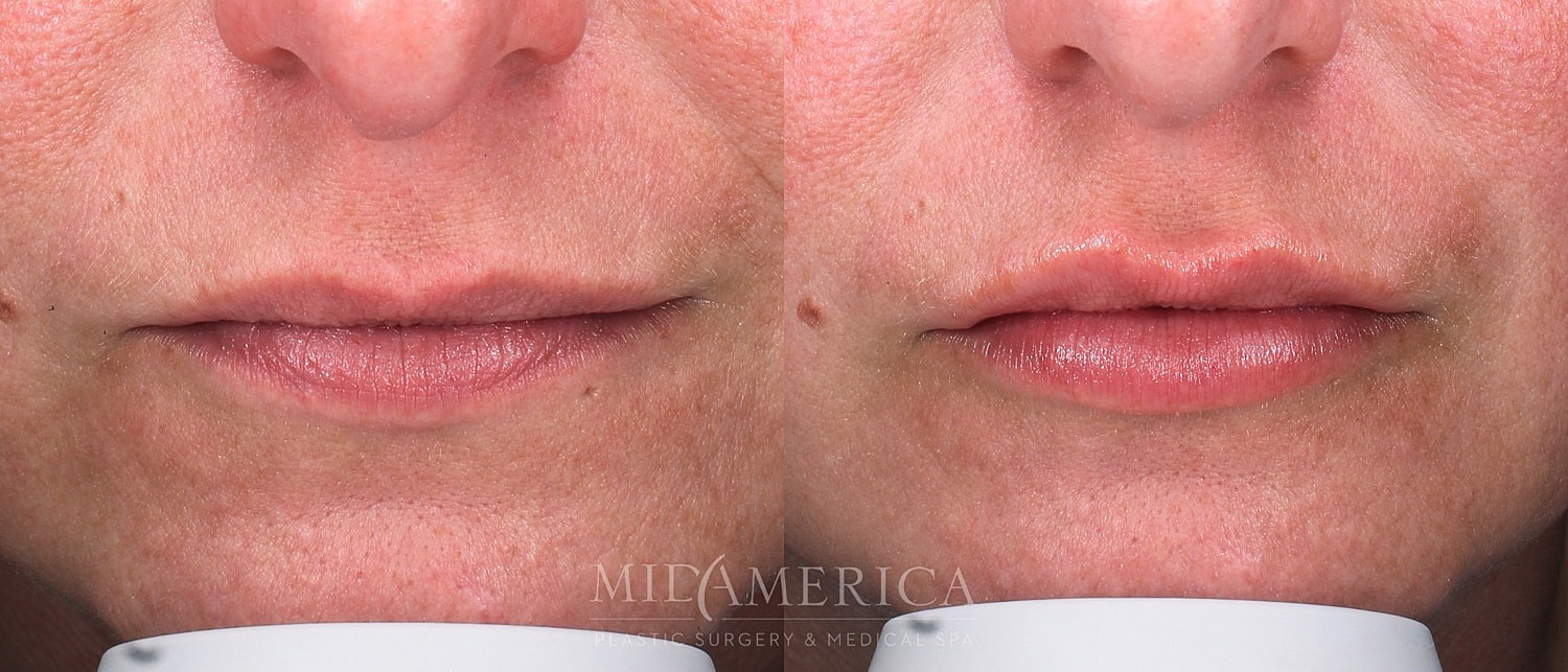Before and after cosmetic lip treatment comparison.