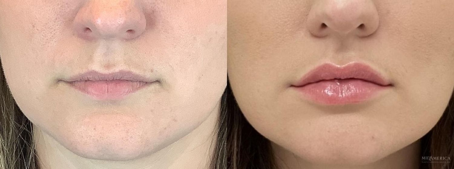 Lip Filler Before & After