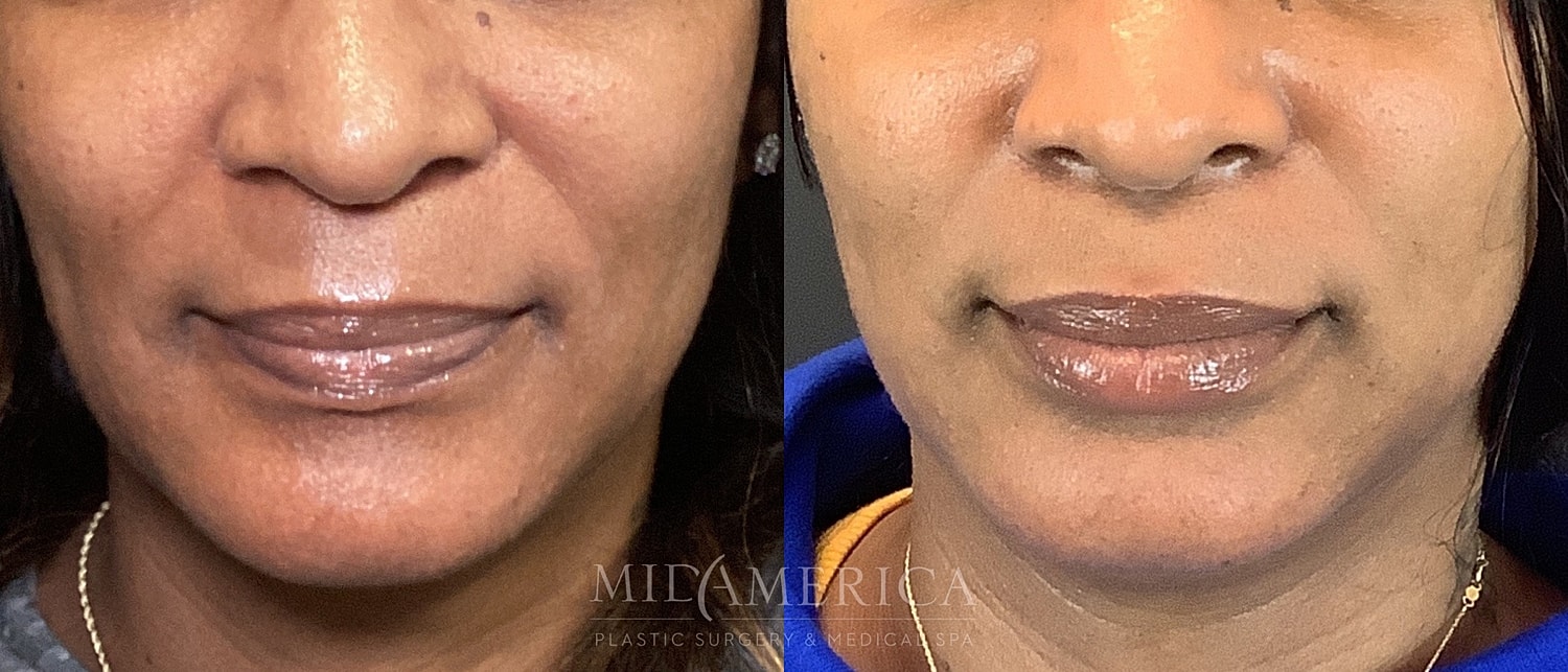 Before and after lip enhancement treatment.