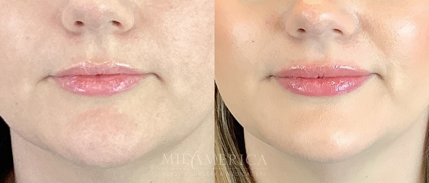 Before and after lip enhancement treatment comparison.
