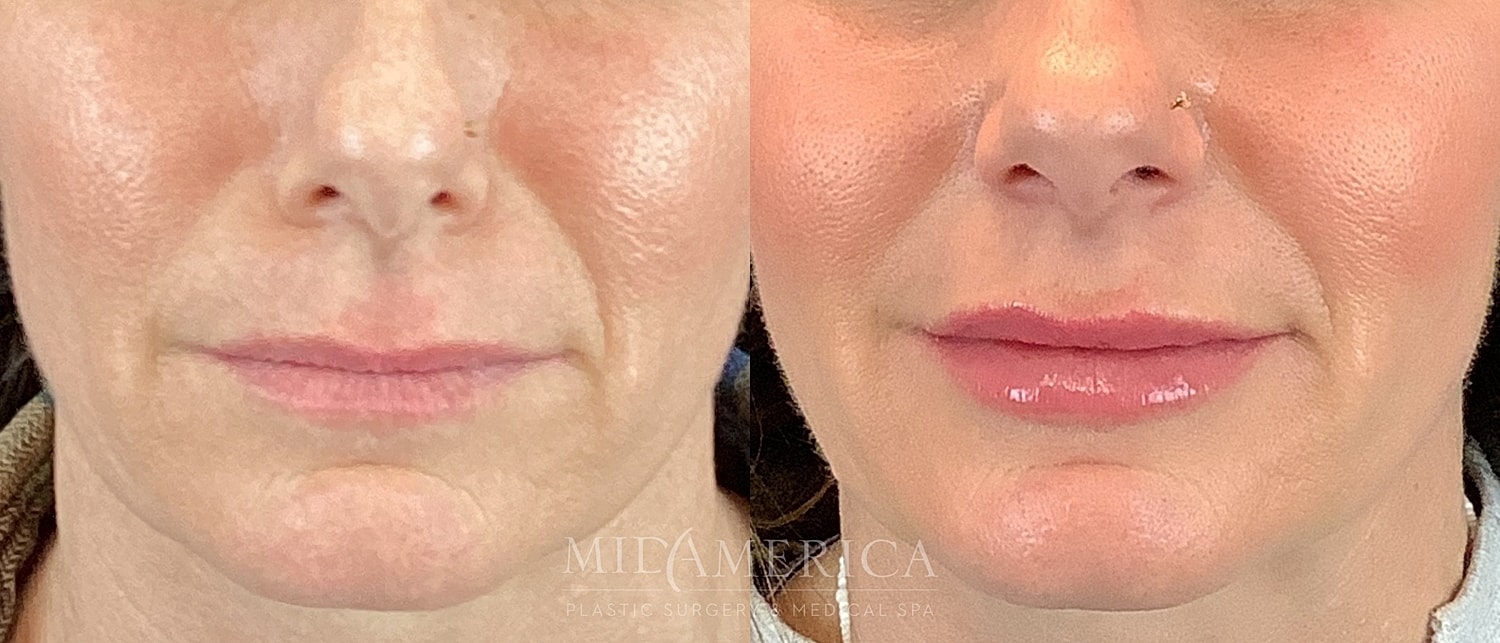 Before and after skin treatment comparison.