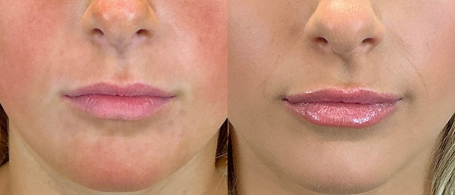 Lip Filler Before & After