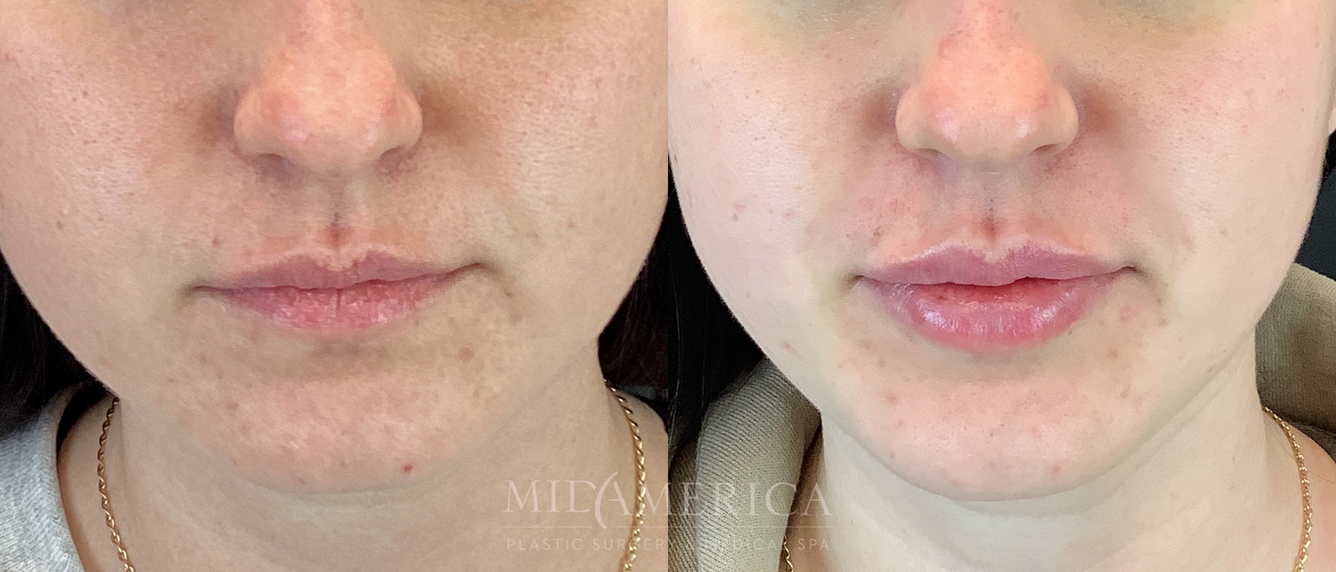 Lip Filler Before & After
