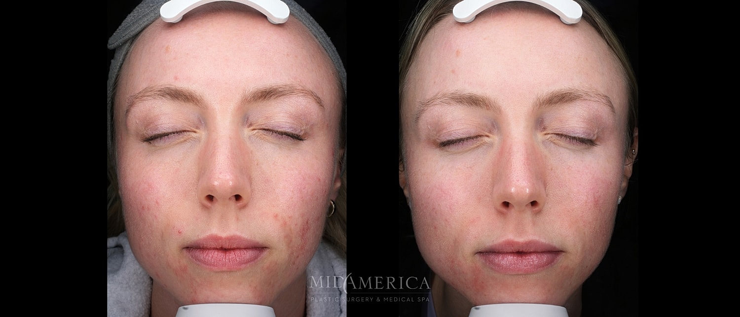 Skin Resurfacing Before & After