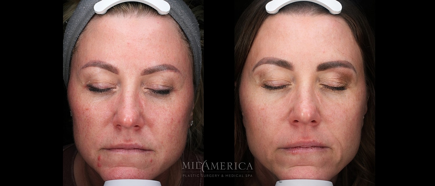 Skin Resurfacing Before & After