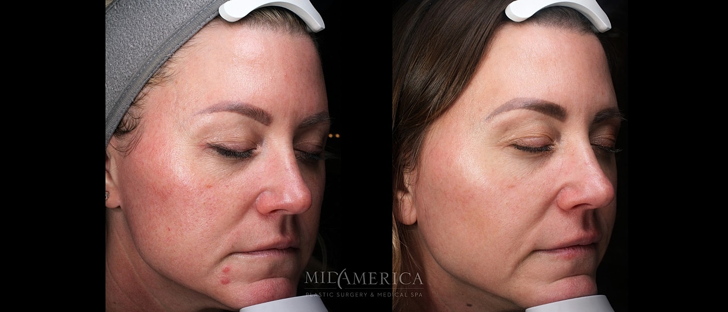 Skin Resurfacing Before & After