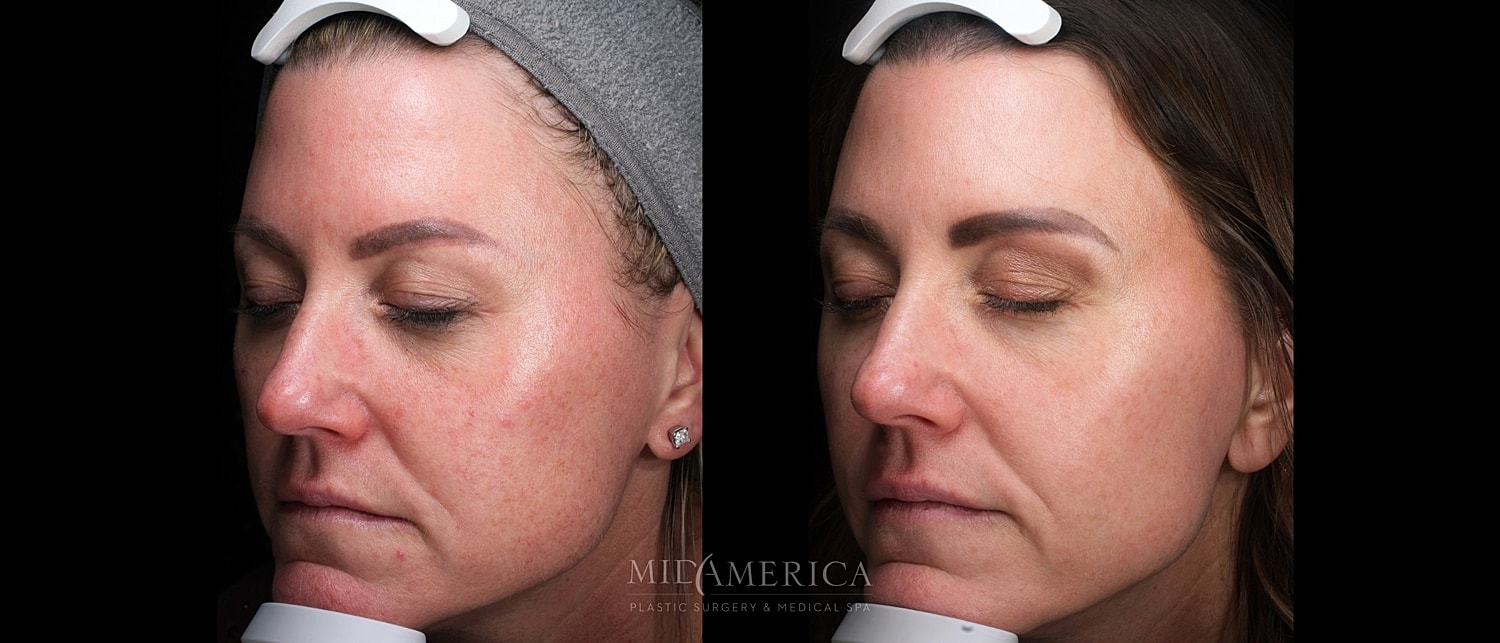 Skin Resurfacing Before & After