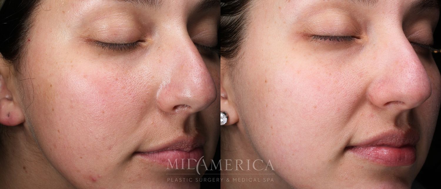 Skin Resurfacing Before & After