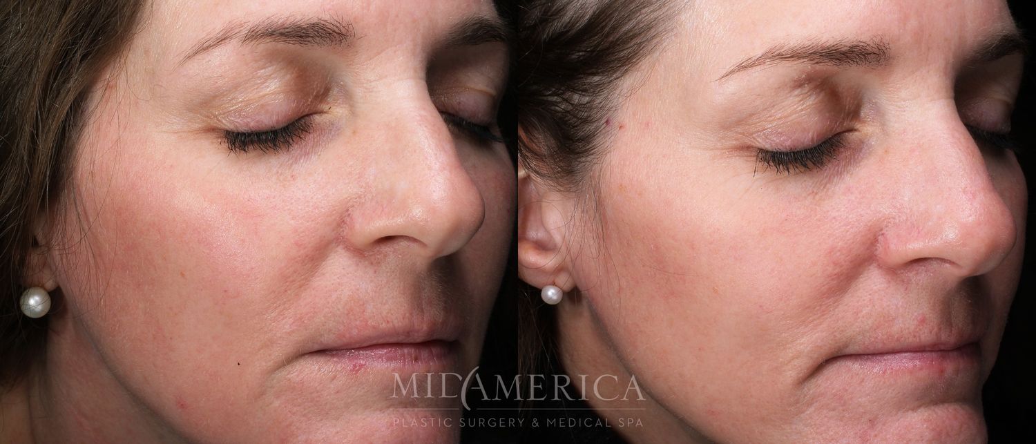 Skin Resurfacing Before & After