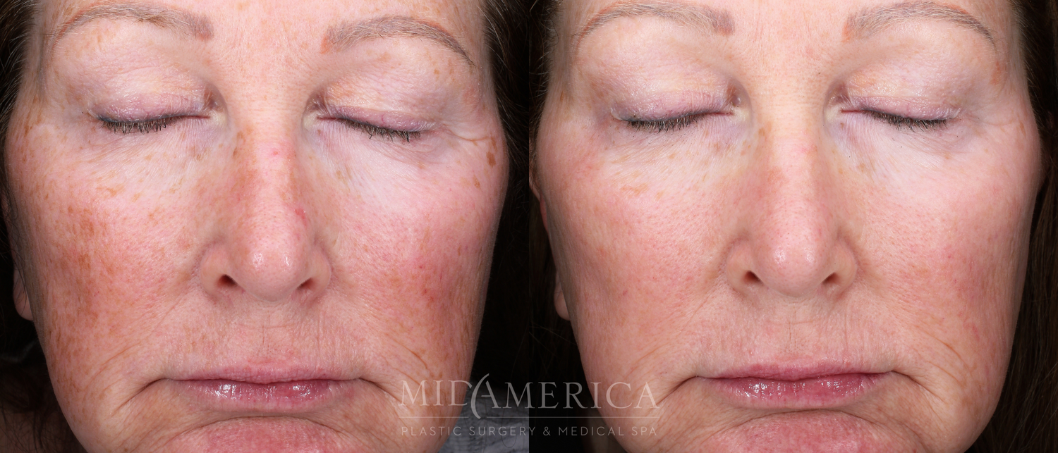 Laser Services Before & After