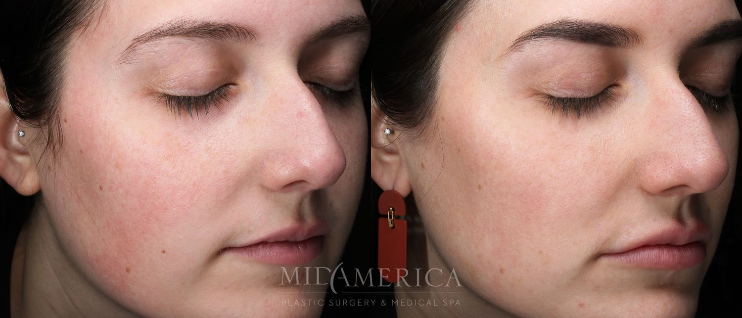 Skin Resurfacing Before & After